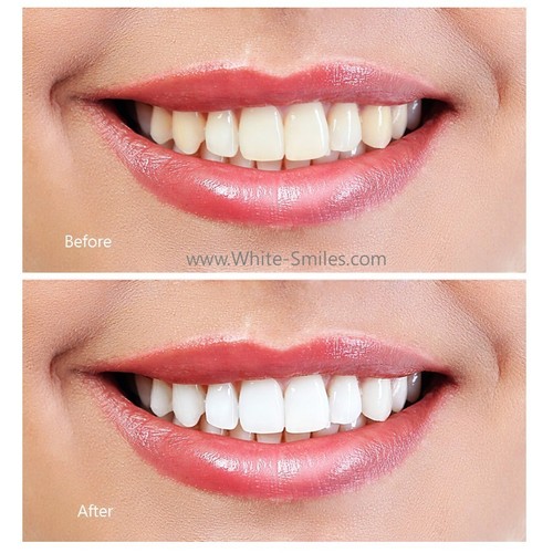 Very strong teeth whitening - very,