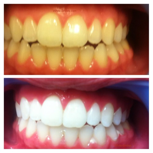 Strong teeth whitening - teeth,