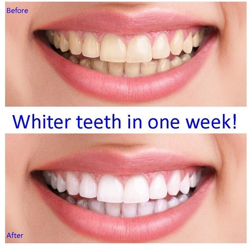 Very strong teeth - very, whitening