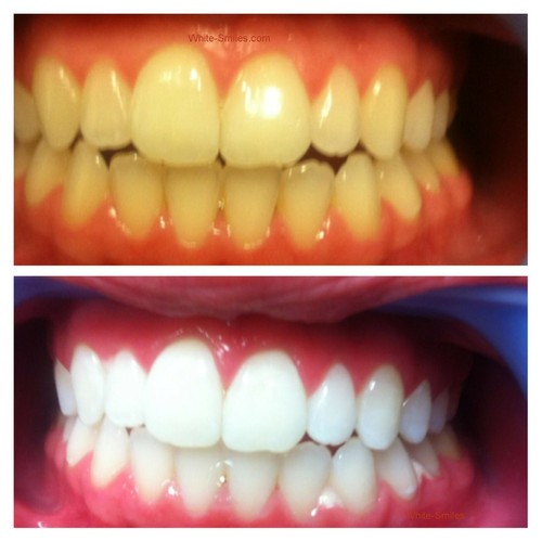 Very strong teeth whitening - very,