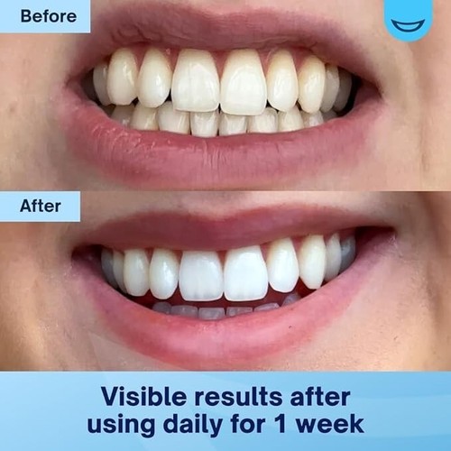 Teeth whitening gel - pen, white