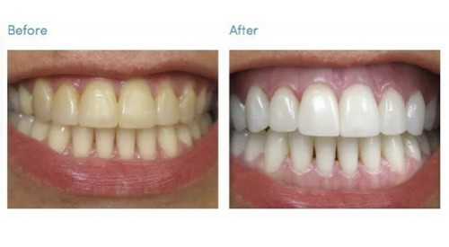 Very strong tooth - very, teeth