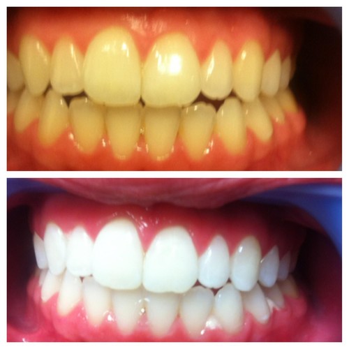 Teeth whitening gel made - whitening,